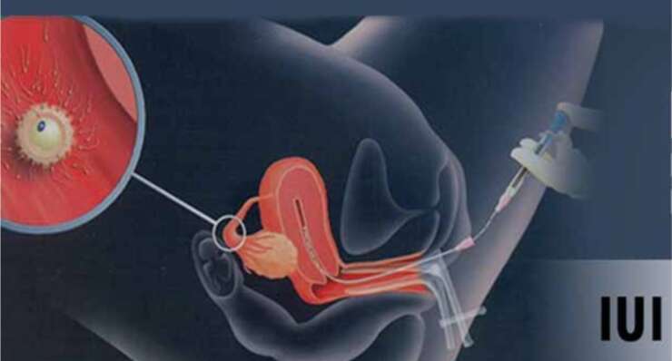 Intra Uterine Insemination (IUI)