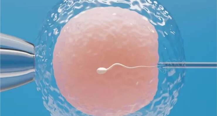 Percutaneous Epididymal Sperm Aspiration (PESA)
