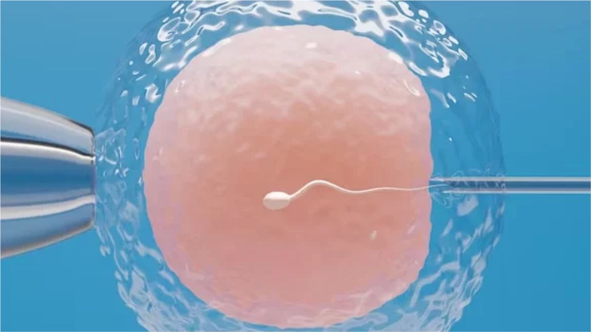 Percutaneous Epididymal Sperm Aspiration (PESA)