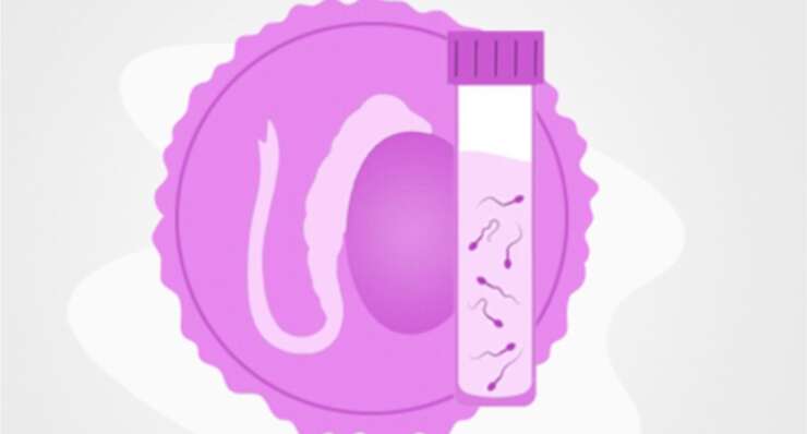 Testicular Sperm Extraction (TESE)